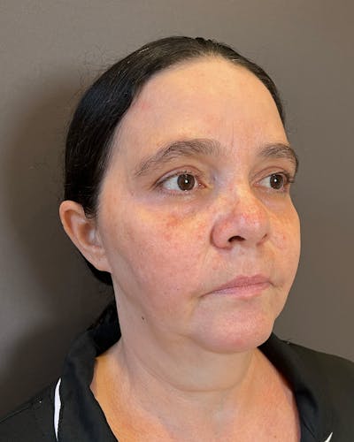 Facelifts / Necklift Before & After Gallery - Patient 415351 - Image 1