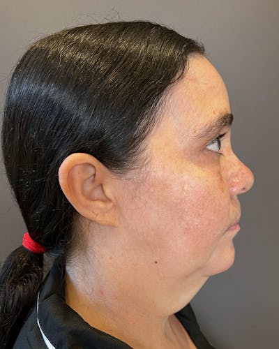 Facelifts / Necklift Before & After Gallery - Patient 415351 - Image 1