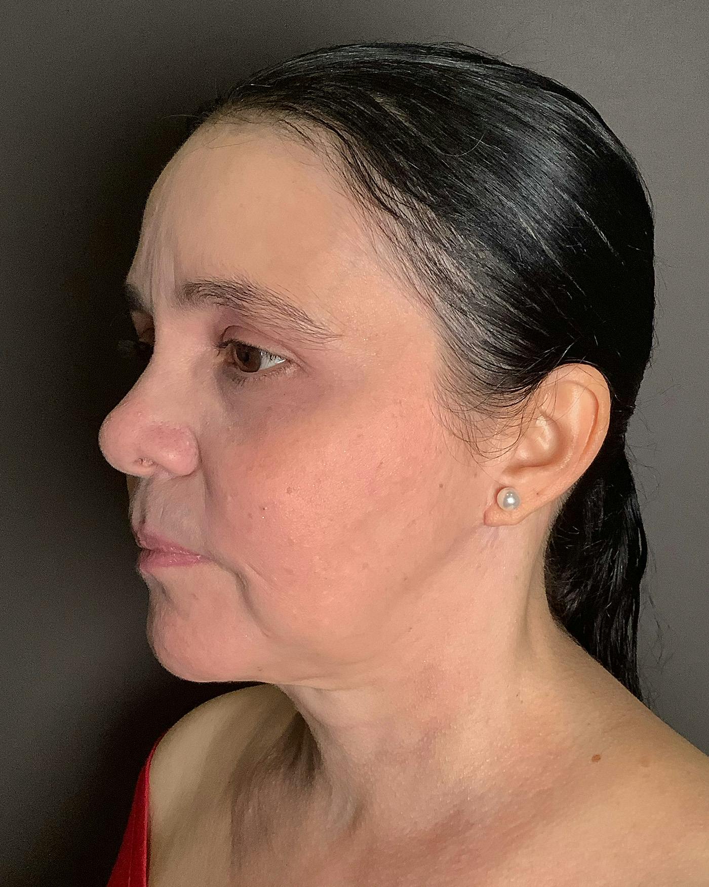 Facelifts / Necklift Before & After Gallery - Patient 415351 - Image 6