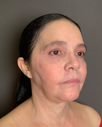 Facelifts / Necklift Before & After Gallery - Patient 415351 - Image 2