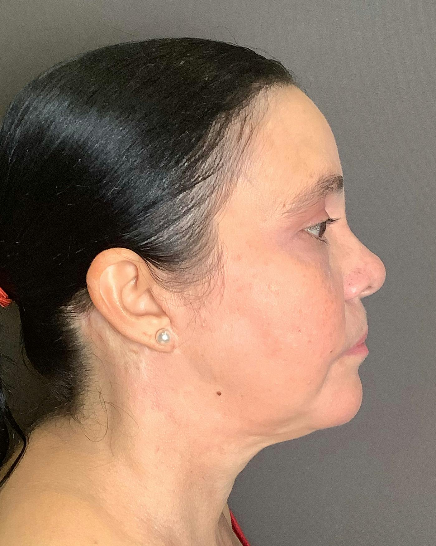 Facelifts / Necklift Before & After Gallery - Patient 415351 - Image 2