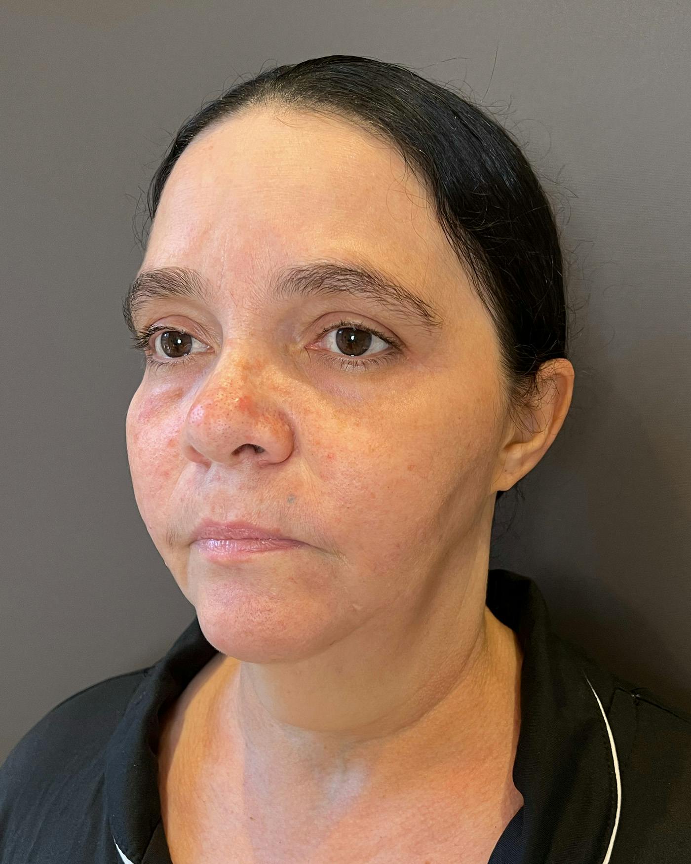 Facelifts / Necklift Before & After Gallery - Patient 415351 - Image 5