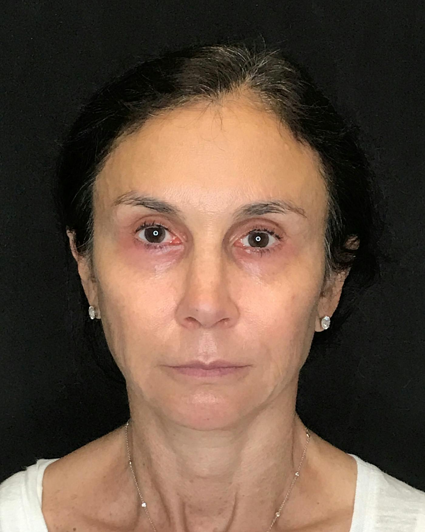 Facial Fat Transfer Before & After Gallery - Patient 340464 - Image 1