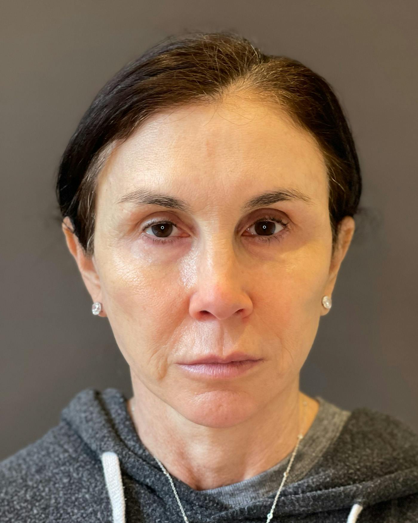 Facial Fat Transfer Before & After Gallery - Patient 340464 - Image 2