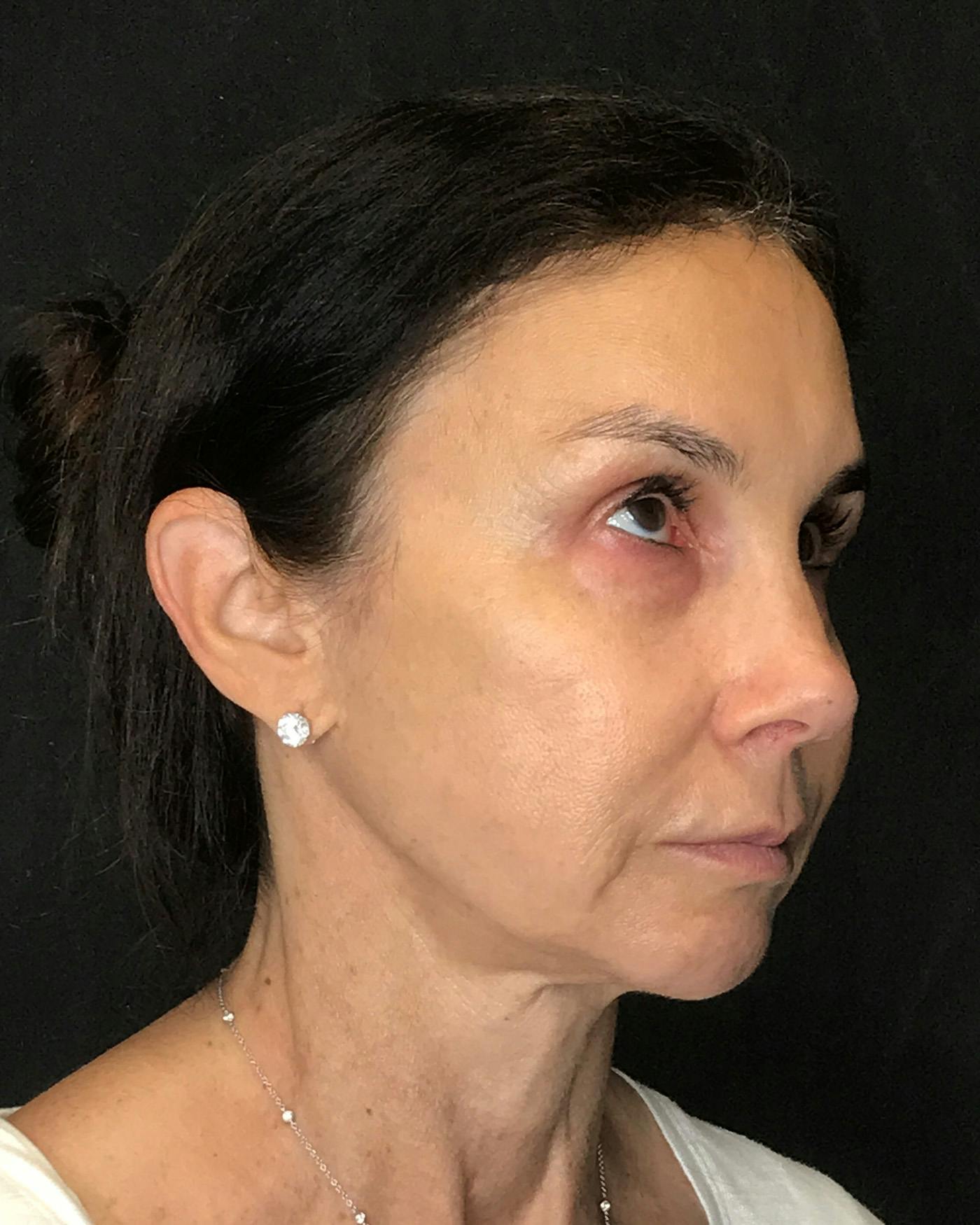 Facial Fat Transfer Before & After Gallery - Patient 340464 - Image 3