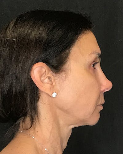Facelifts / Necklift Before & After Gallery - Patient 415604 - Image 1