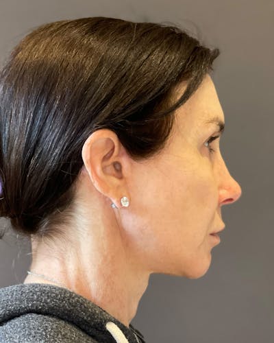 Facelifts / Necklift Before & After Gallery - Patient 415604 - Image 2