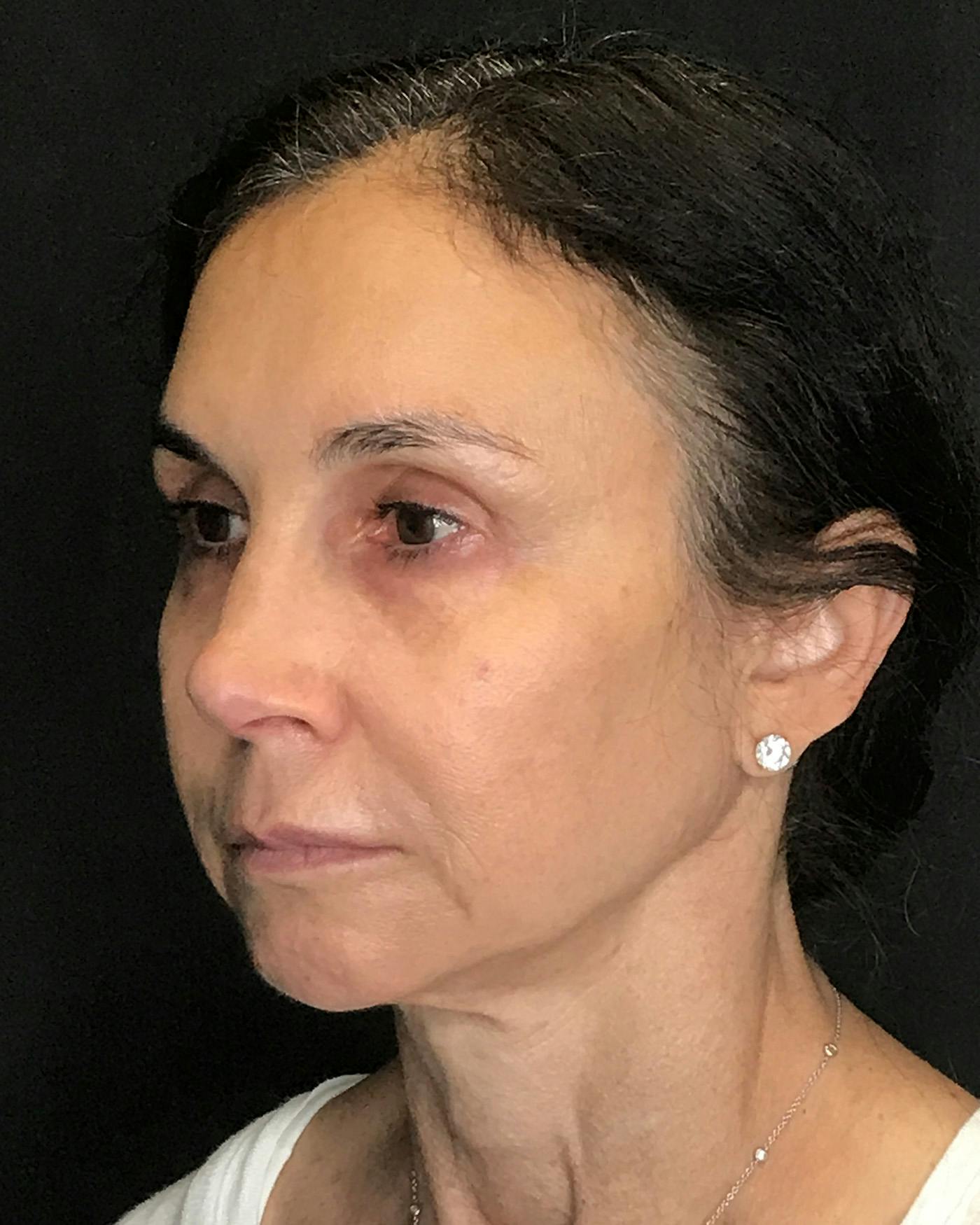 Facial Fat Transfer Before & After Gallery - Patient 340464 - Image 7