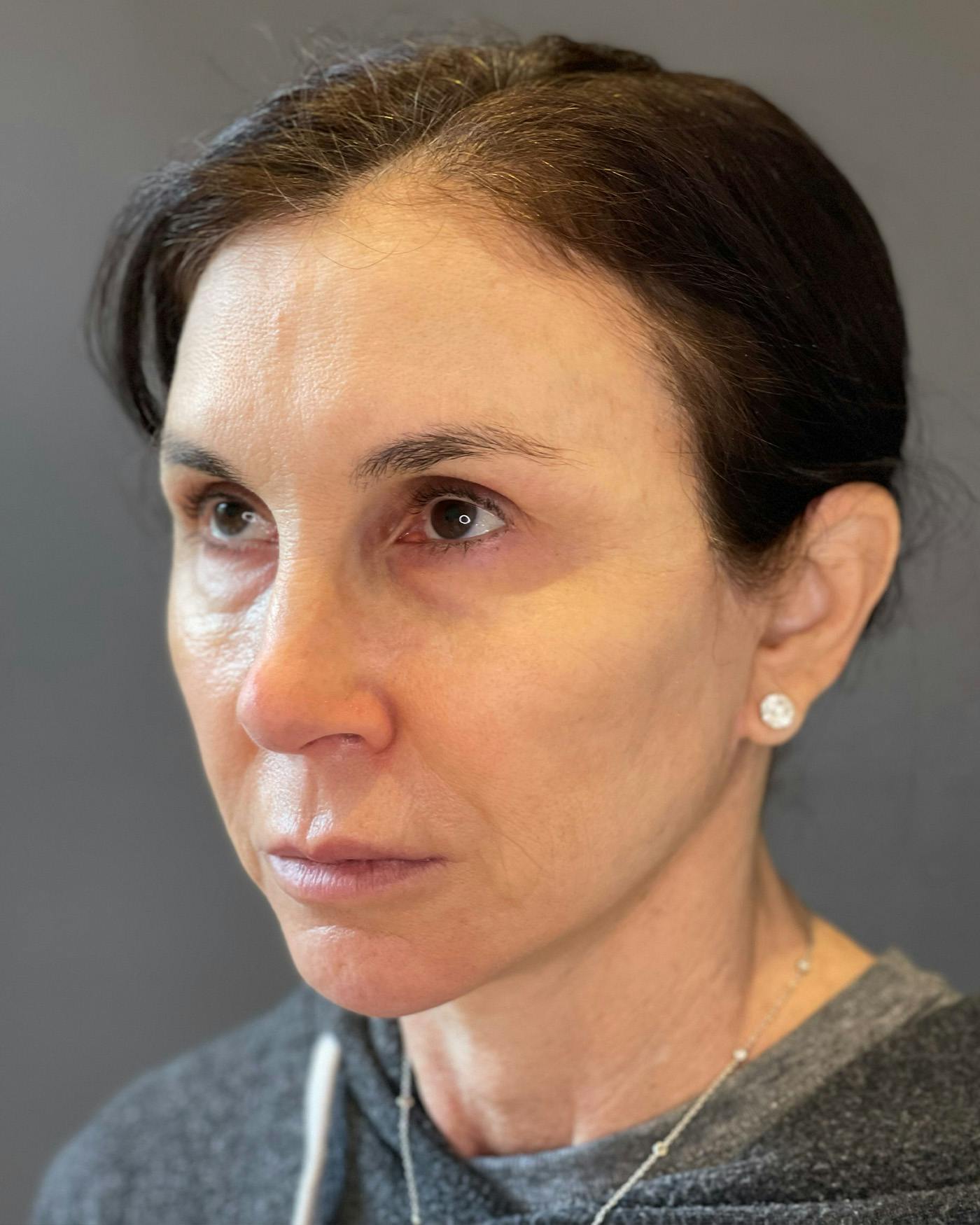 Facial Fat Transfer Before & After Gallery - Patient 340464 - Image 8