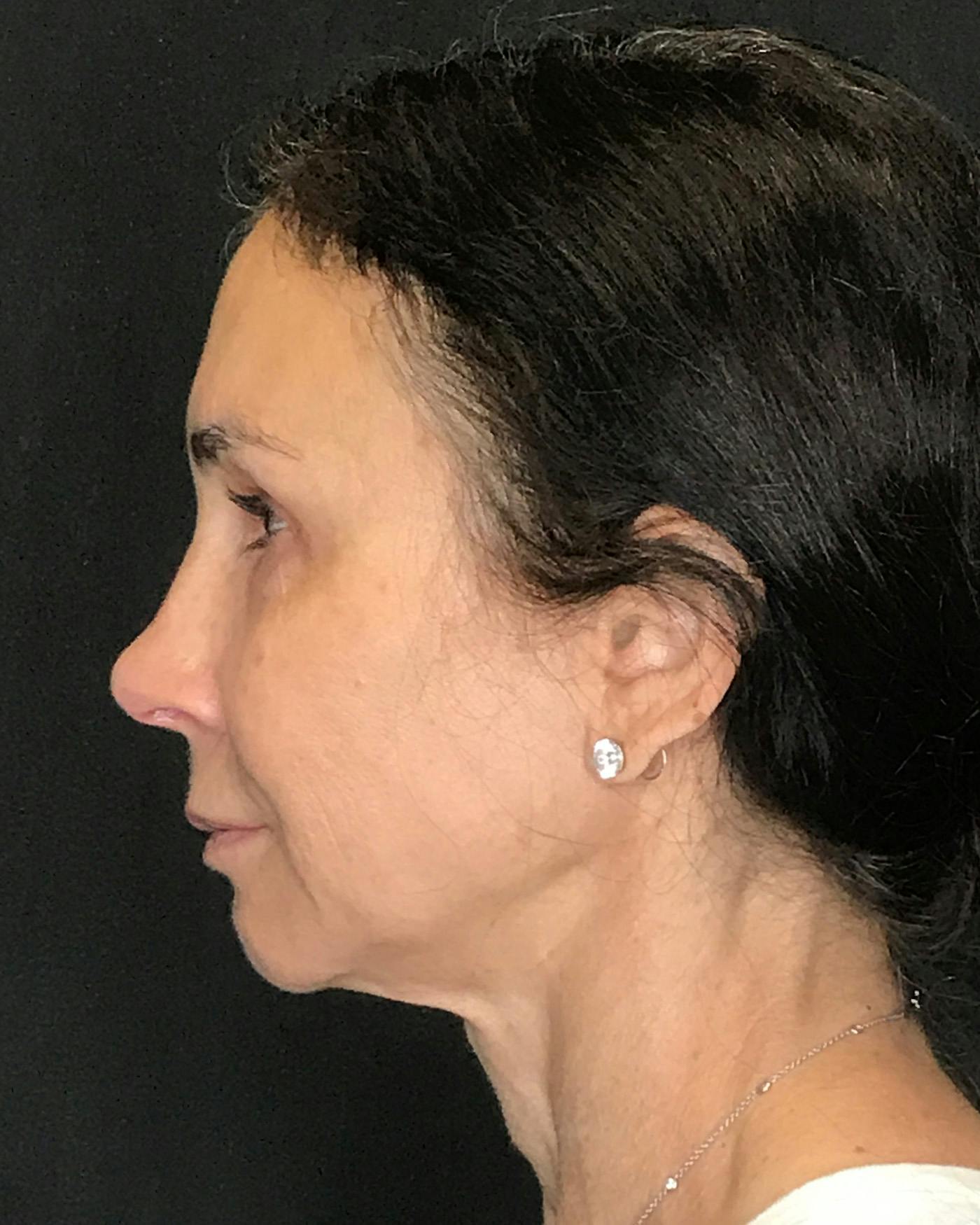 Facial Fat Transfer Before & After Gallery - Patient 340464 - Image 9