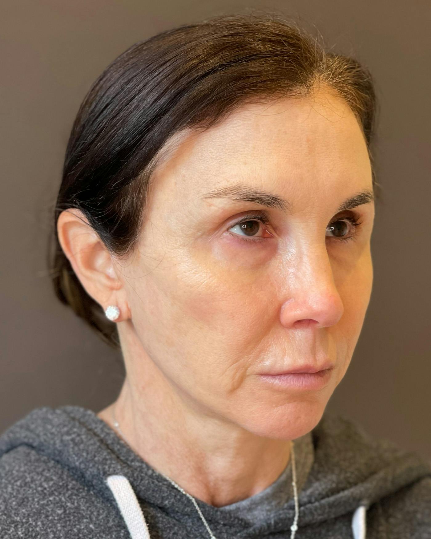 Facial Fat Transfer Before & After Gallery - Patient 340464 - Image 4