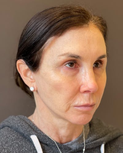 Facelifts / Necklift Before & After Gallery - Patient 415604 - Image 2