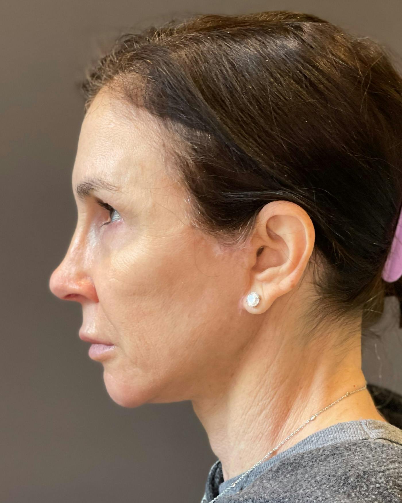 Facial Fat Transfer Before & After Gallery - Patient 340464 - Image 10