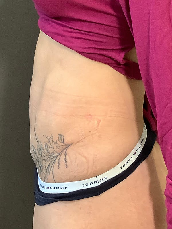 Tummy Tuck Before & After Gallery - Patient 363352 - Image 10