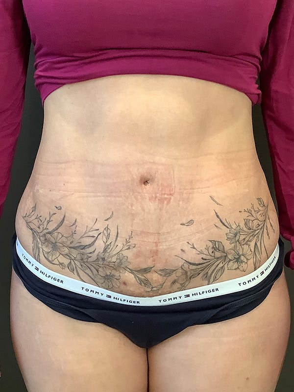 Tummy Tuck Before & After Gallery - Patient 363352 - Image 2