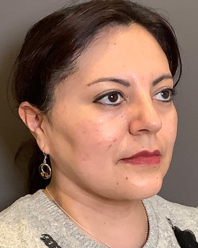 Liposuction Before & After Gallery - Patient 115675 - Image 2