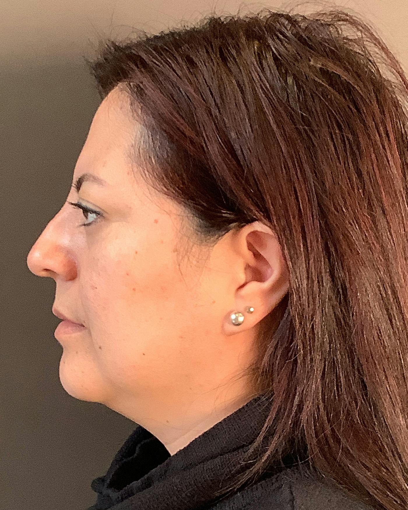 Liposuction Before & After Gallery - Patient 115675 - Image 7