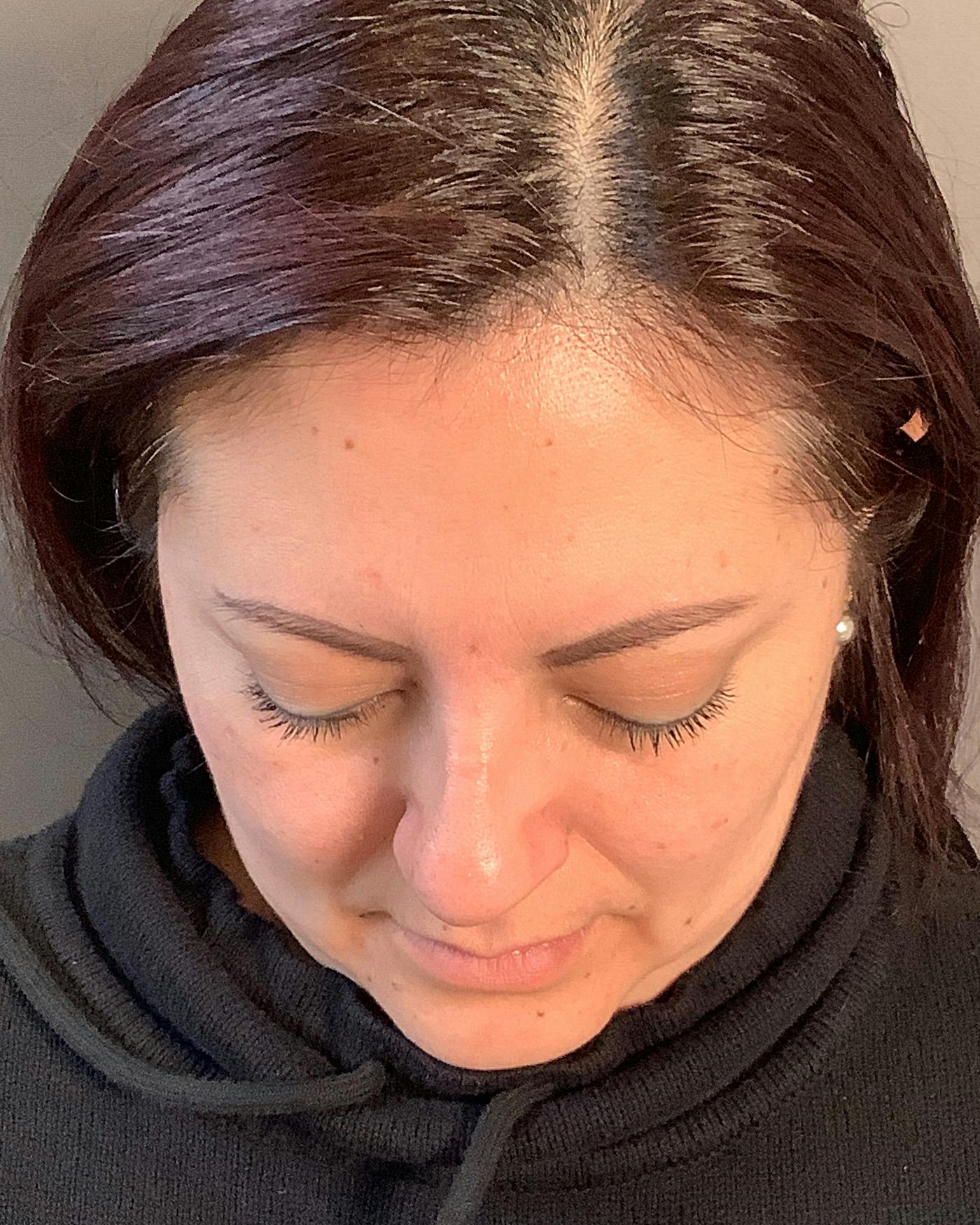 Liposuction Before & After Gallery - Patient 115675 - Image 11