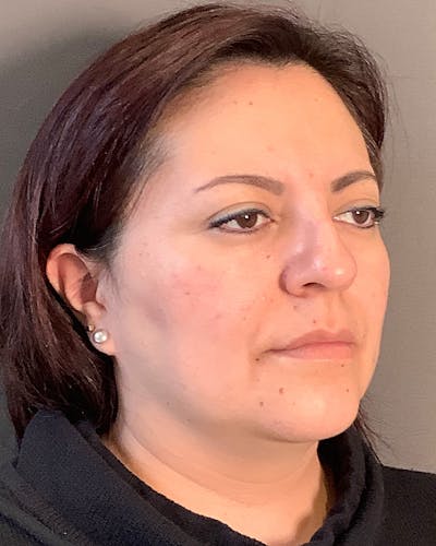 Liposuction Before & After Gallery - Patient 115675 - Image 1