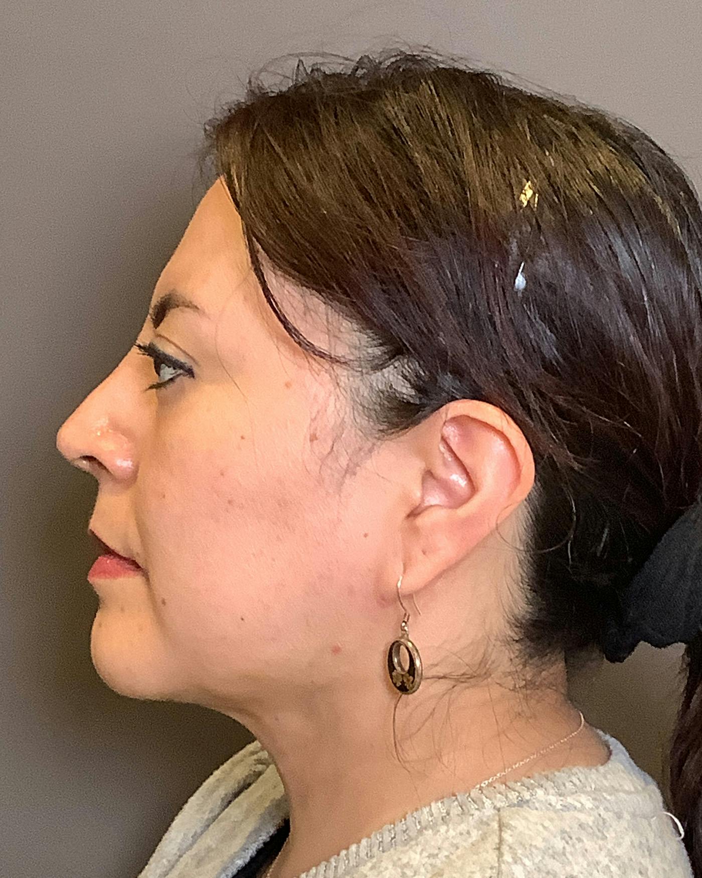 Liposuction Before & After Gallery - Patient 115675 - Image 8