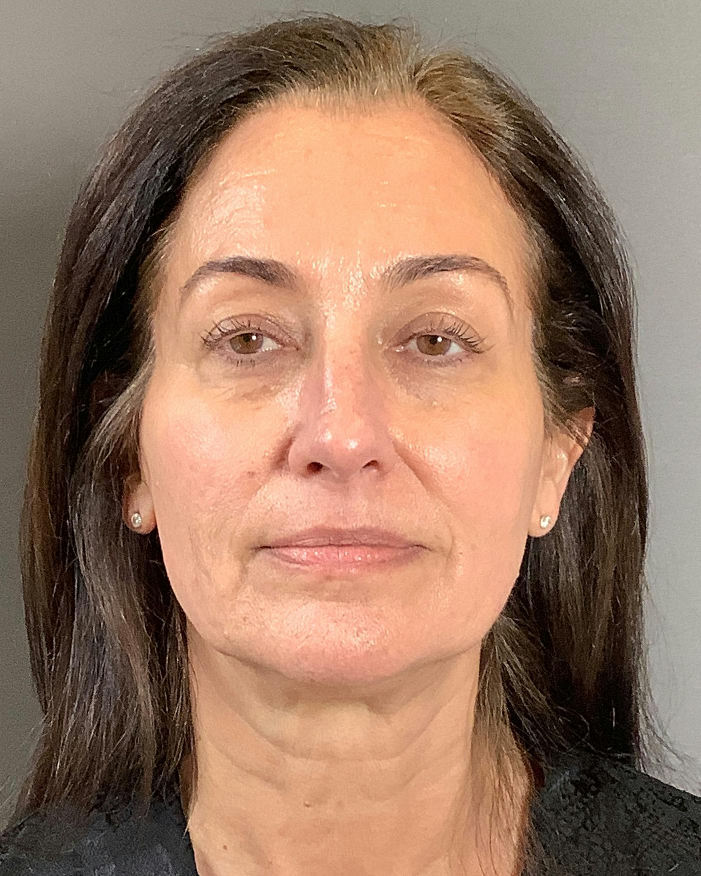 Facelifts / Necklift Before & After Gallery - Patient 163098 - Image 1