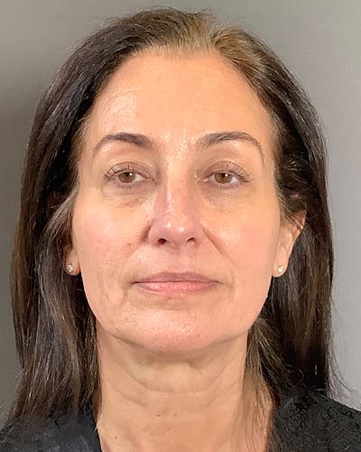 Facelifts / Necklift Before & After Gallery - Patient 163098 - Image 1