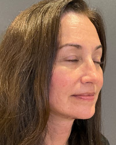 Facelifts / Necklift Before & After Gallery - Patient 163098 - Image 2