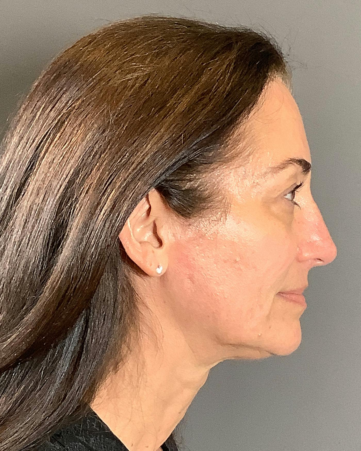Facelifts / Necklift Before & After Gallery - Patient 163098 - Image 5