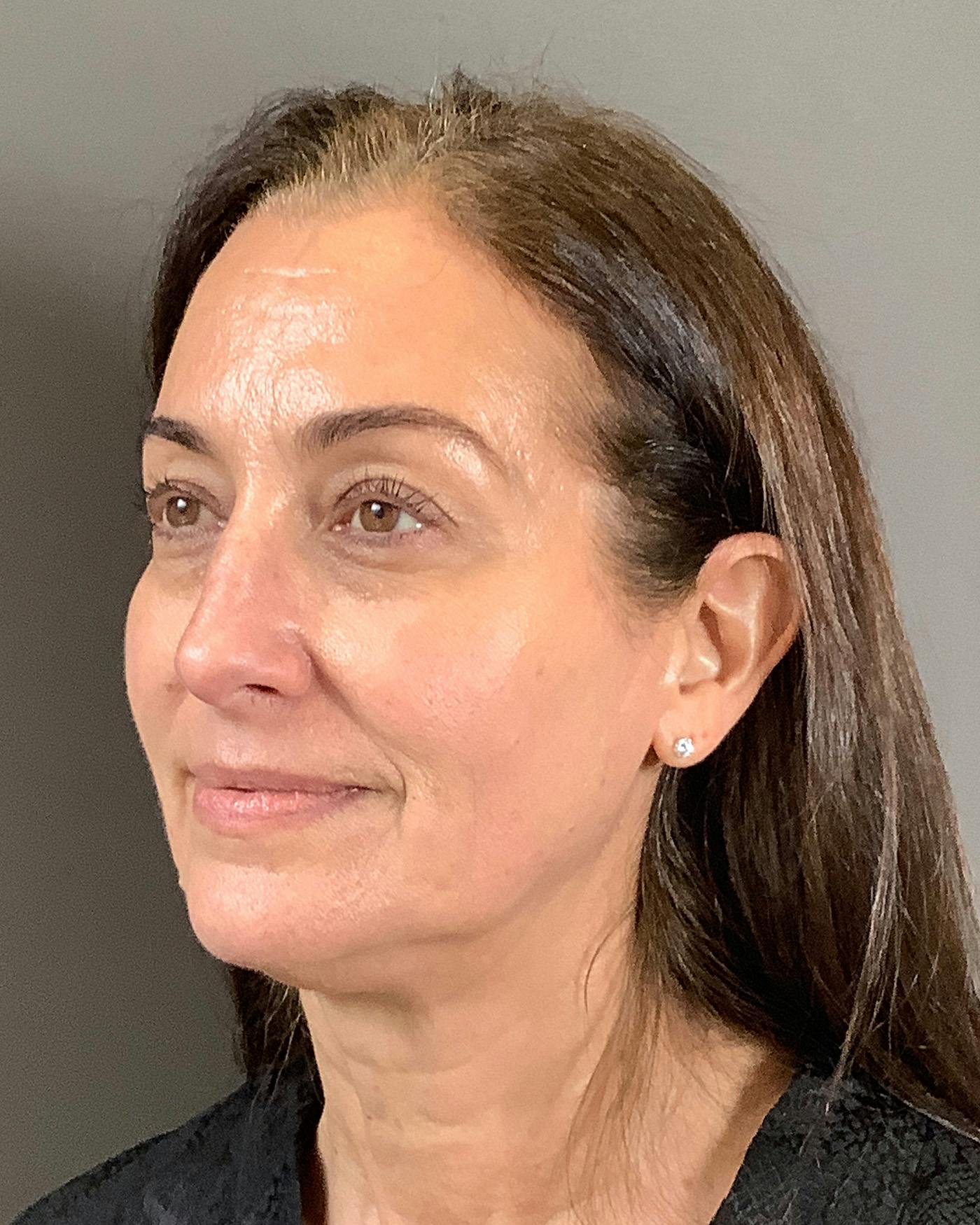 Facelifts / Necklift Before & After Gallery - Patient 163098 - Image 7