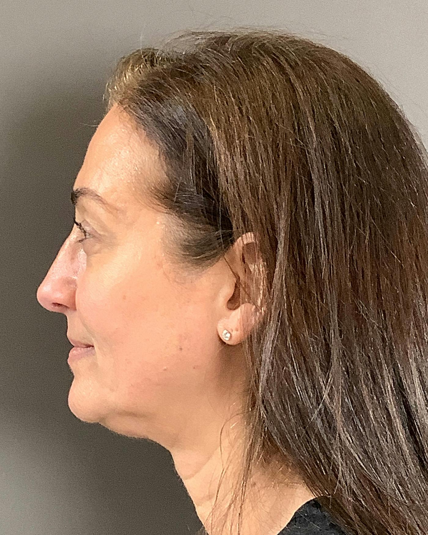 Facelifts / Necklift Before & After Gallery - Patient 163098 - Image 9