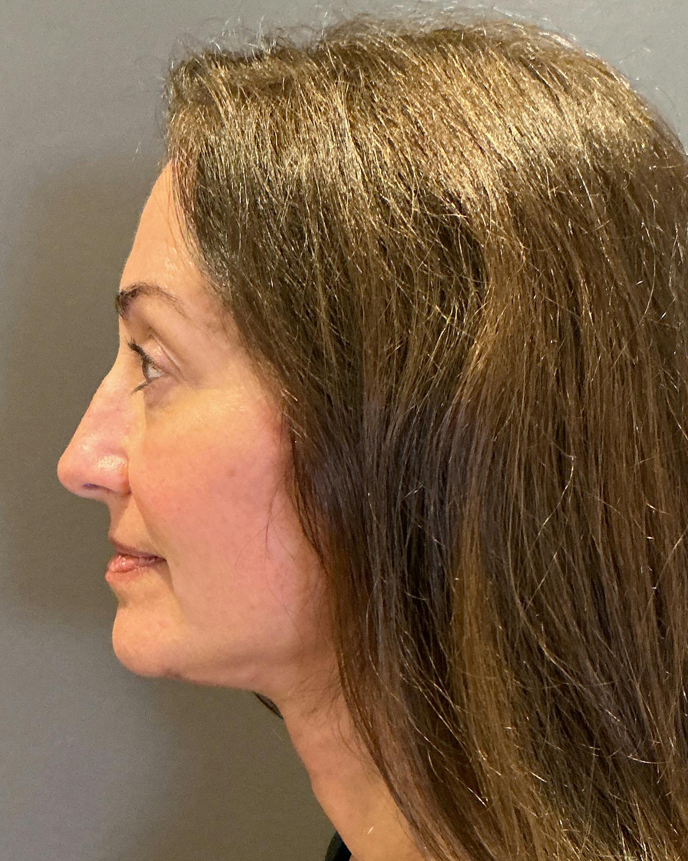 Facelifts / Necklift Before & After Gallery - Patient 163098 - Image 10