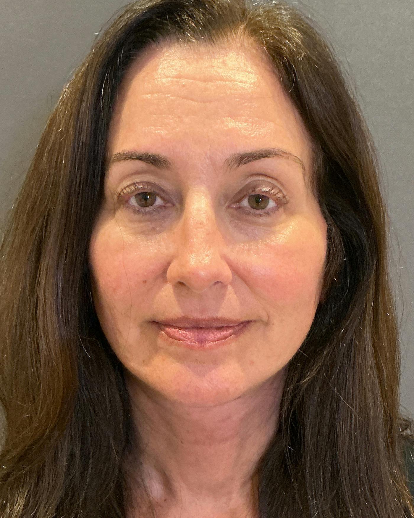 Facelifts / Necklift Before & After Gallery - Patient 163098 - Image 2