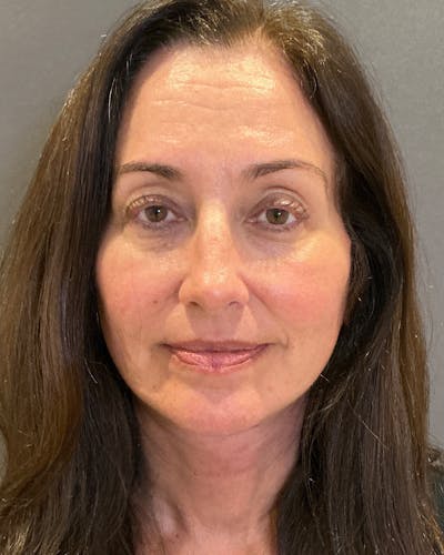 Facelifts / Necklift Before & After Gallery - Patient 163098 - Image 2