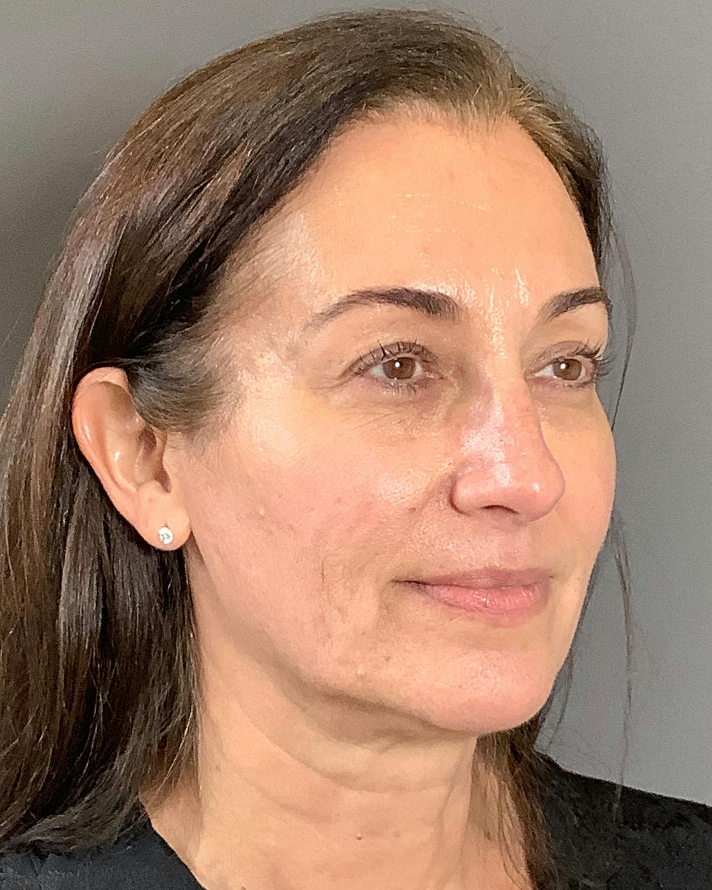 Facelifts / Necklift Before & After Gallery - Patient 163098 - Image 3