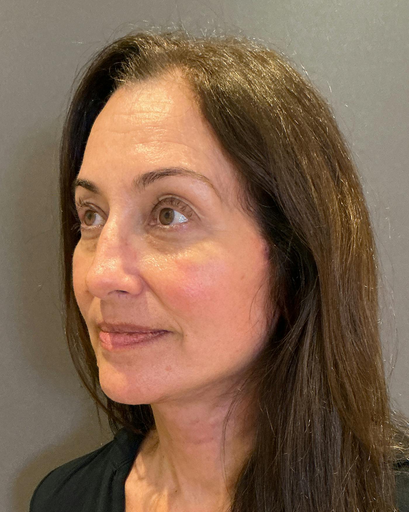 Facelifts / Necklift Before & After Gallery - Patient 163098 - Image 8