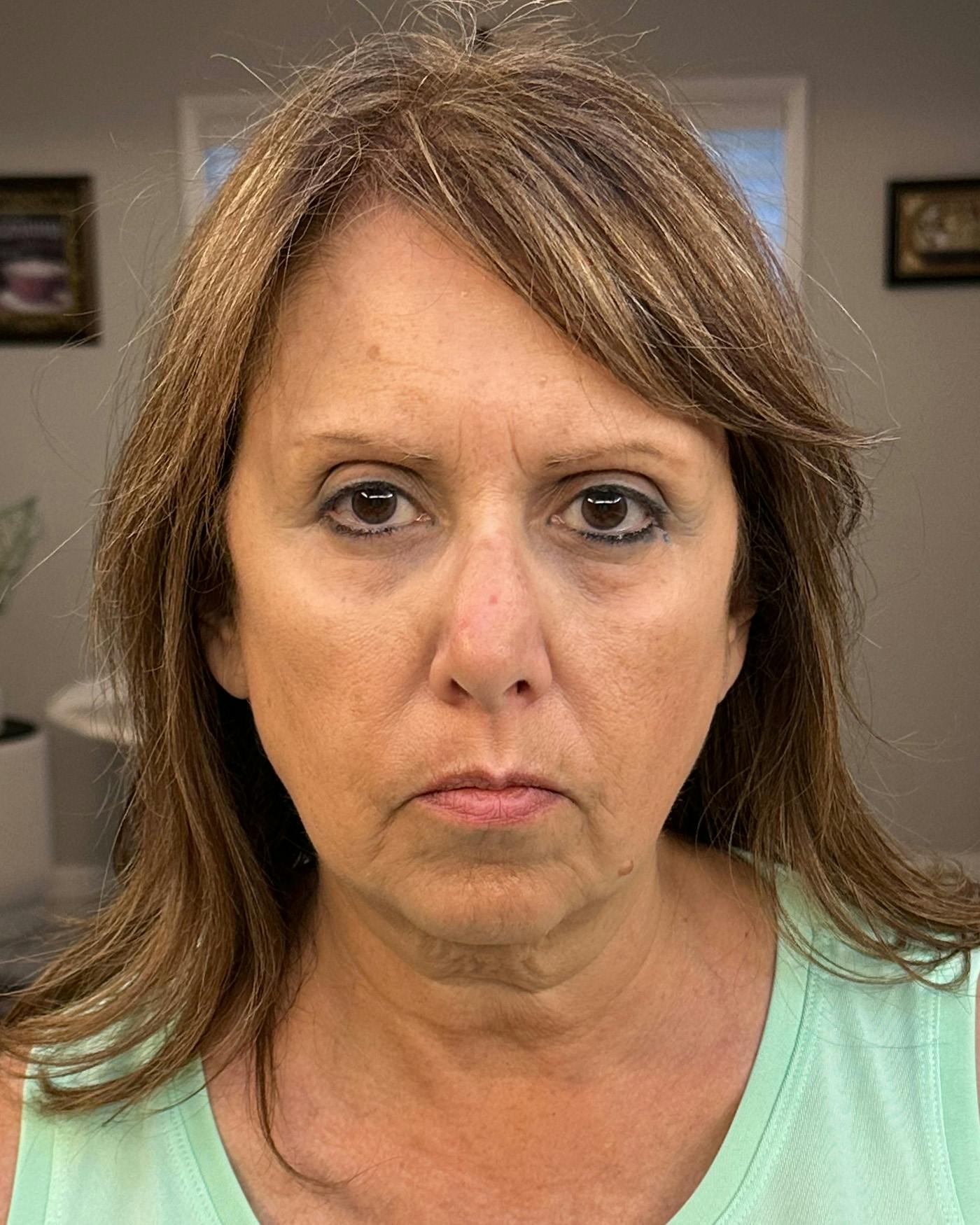 Facial Fat Transfer Before & After Gallery - Patient 174103 - Image 1