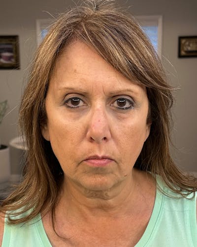 Facial Fat Transfer Before & After Gallery - Patient 174103 - Image 1