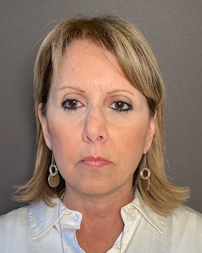 Facial Fat Transfer Before & After Gallery - Patient 174103 - Image 2