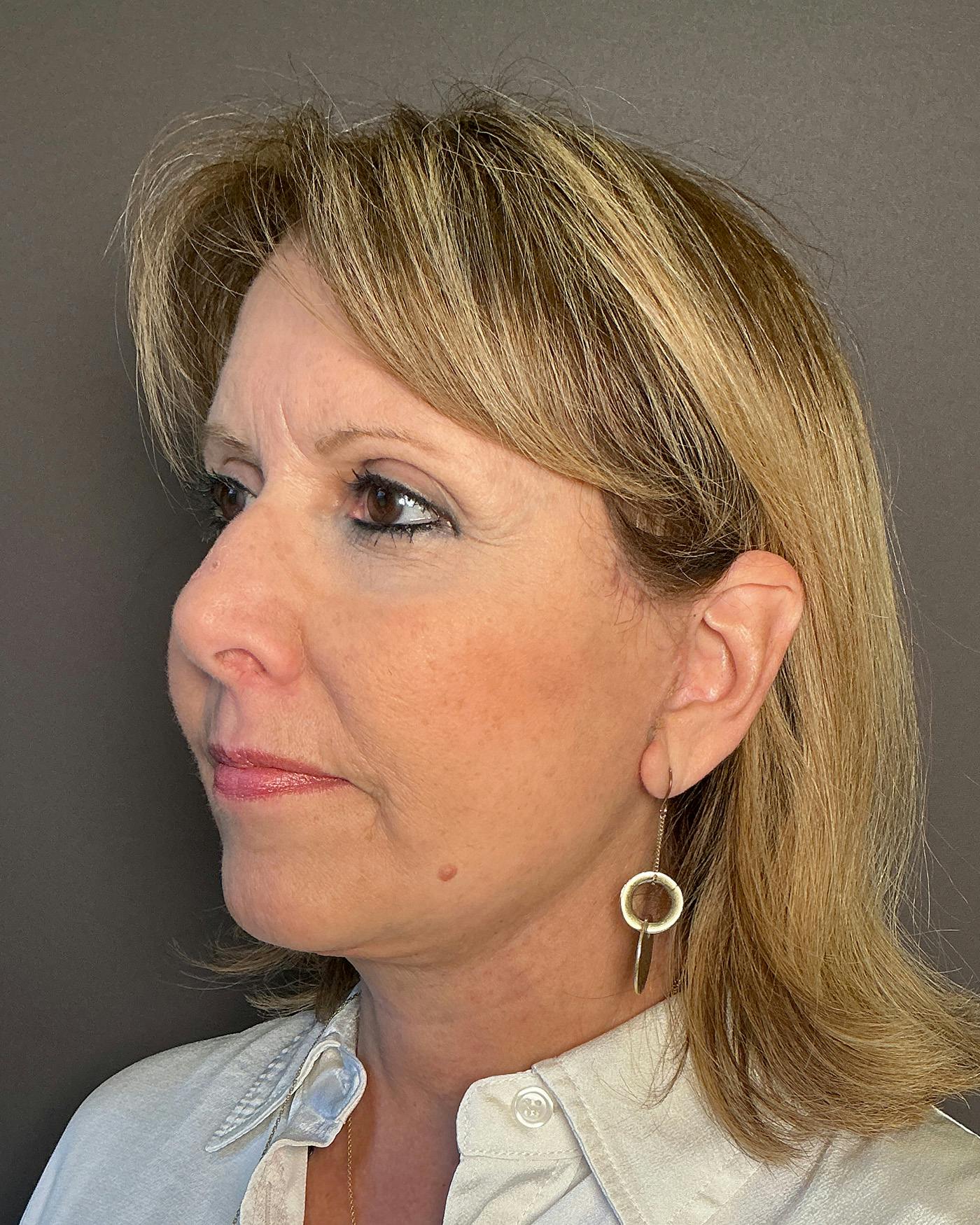 Facial Fat Transfer Before & After Gallery - Patient 174103 - Image 6