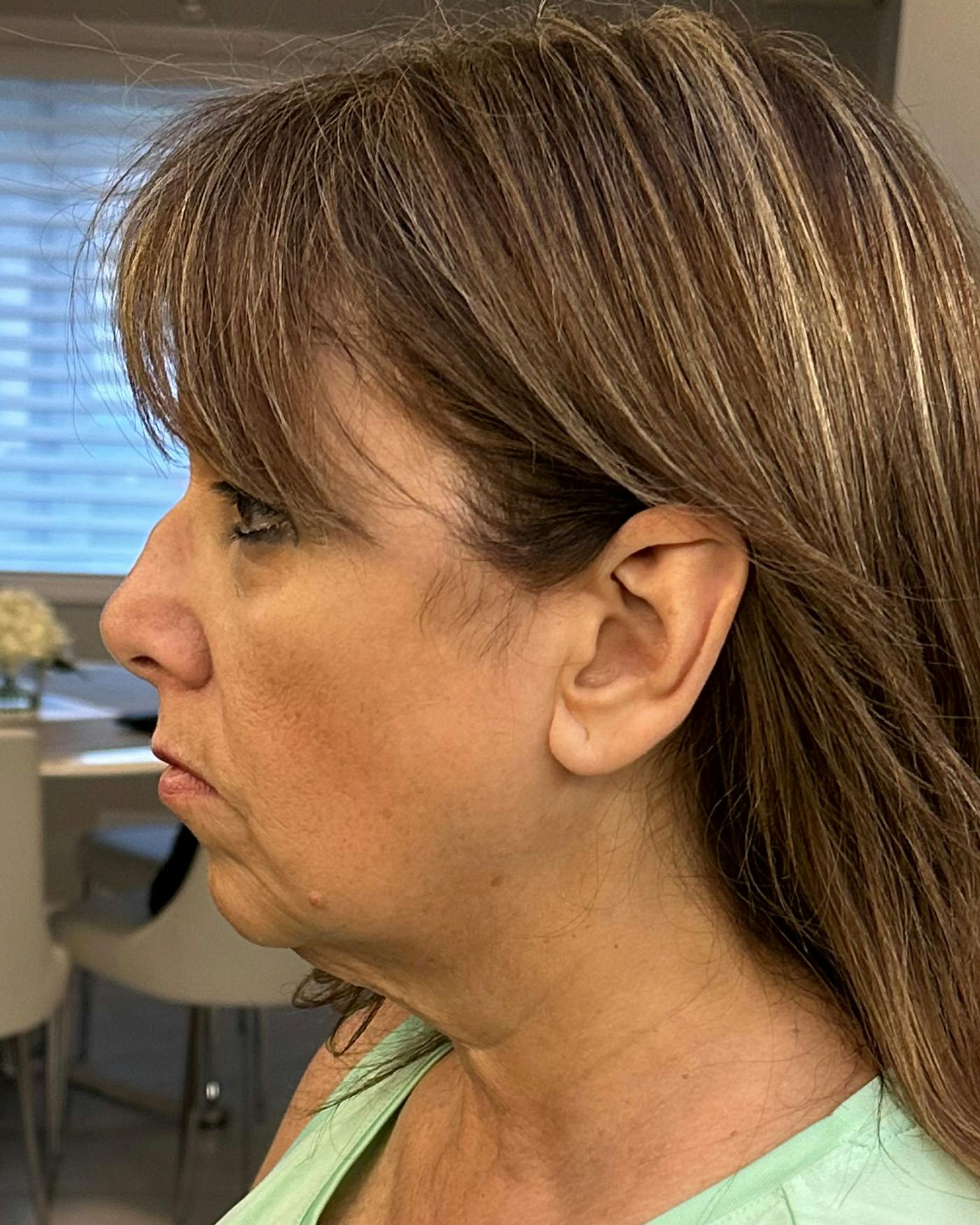 Facial Fat Transfer Before & After Gallery - Patient 174103 - Image 7