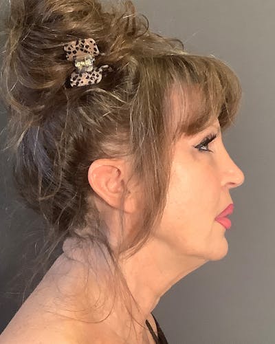 Revision Rhinoplasty Before & After Gallery - Patient 245151 - Image 1