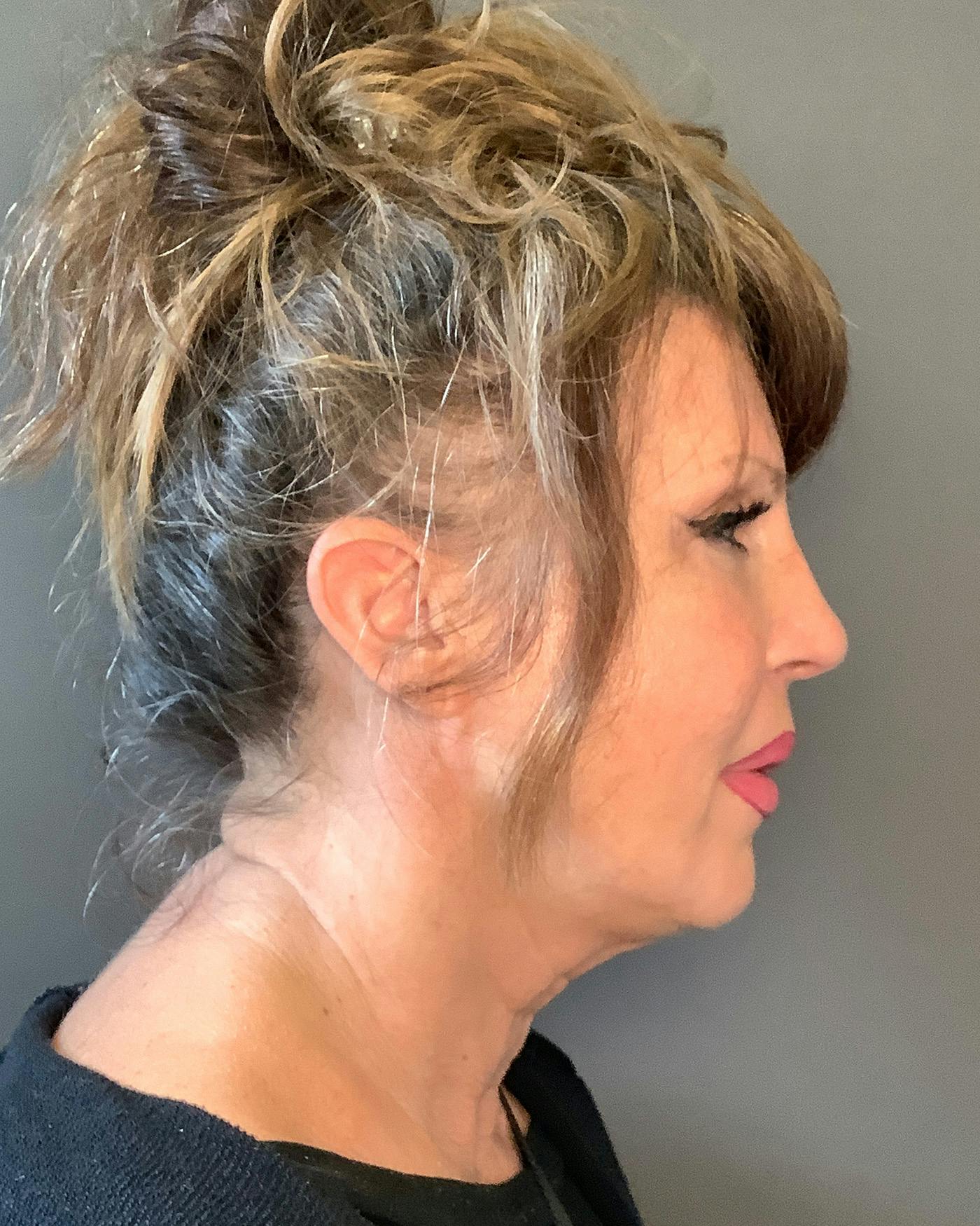 Revision Rhinoplasty Before & After Gallery - Patient 245151 - Image 2
