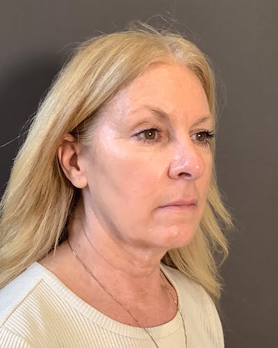 Facelifts / Necklift Before & After Gallery - Patient 422649 - Image 1
