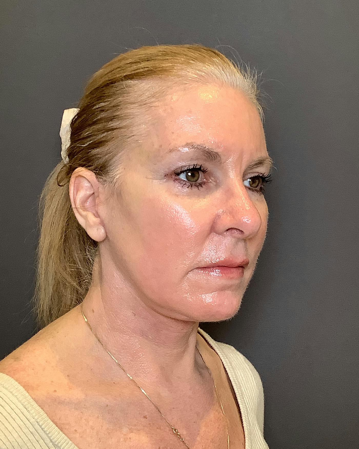 CO2 Full Face Before & After Gallery - Patient 407428 - Image 4