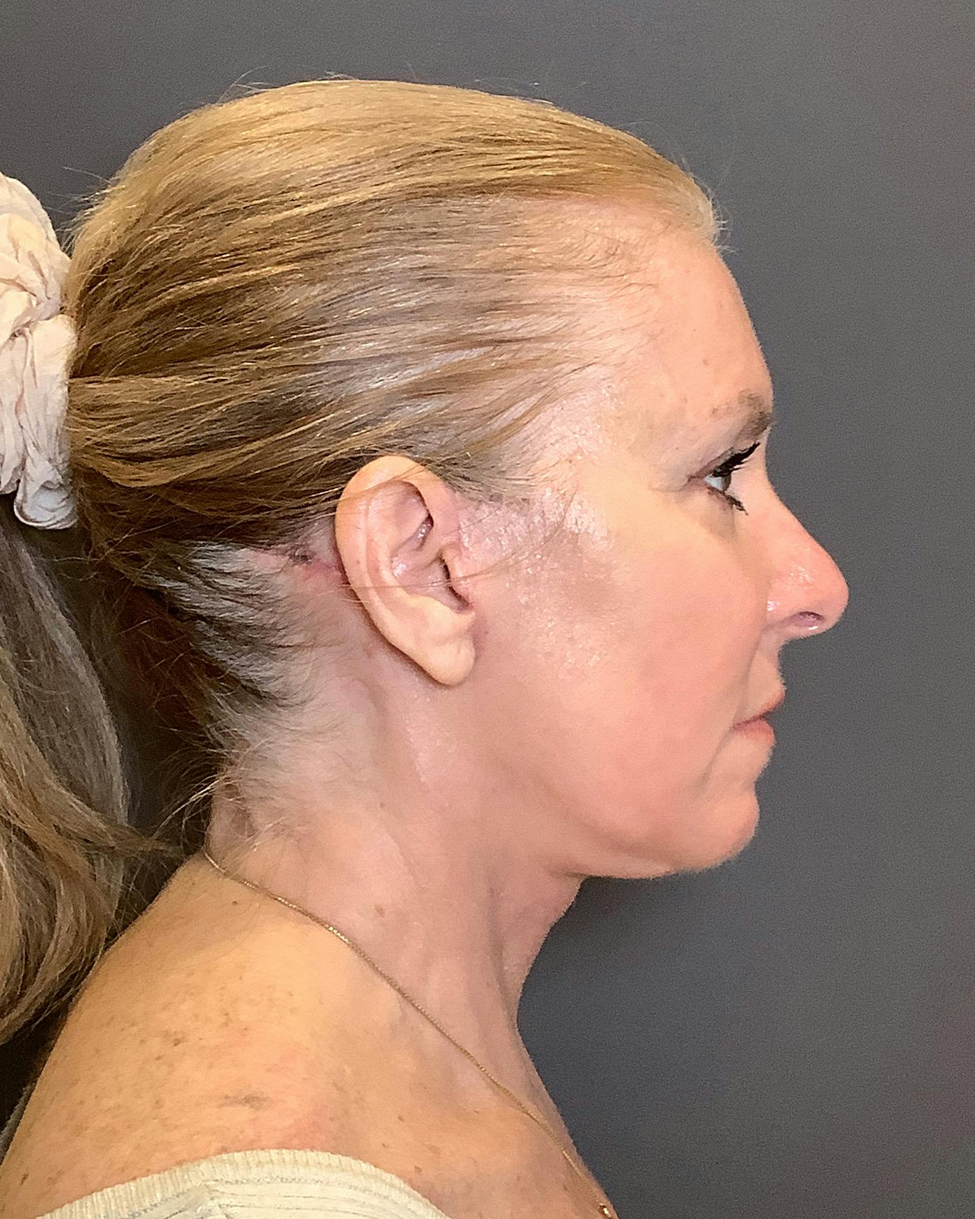 CO2 Full Face Before & After Gallery - Patient 407428 - Image 6