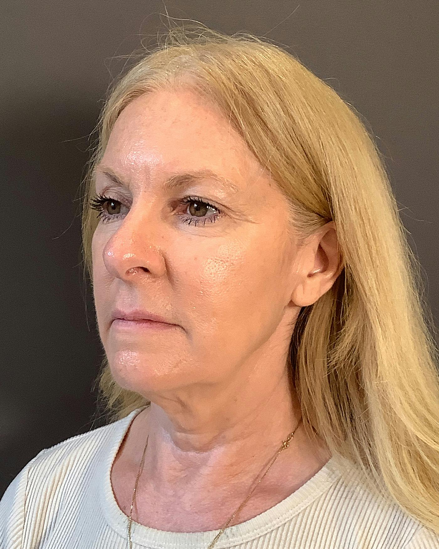 CO2 Full Face Before & After Gallery - Patient 407428 - Image 7