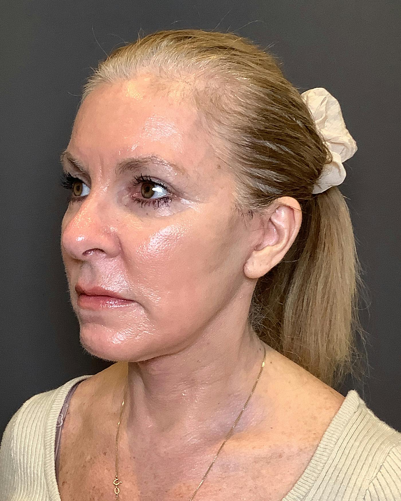 CO2 Full Face Before & After Gallery - Patient 407428 - Image 8