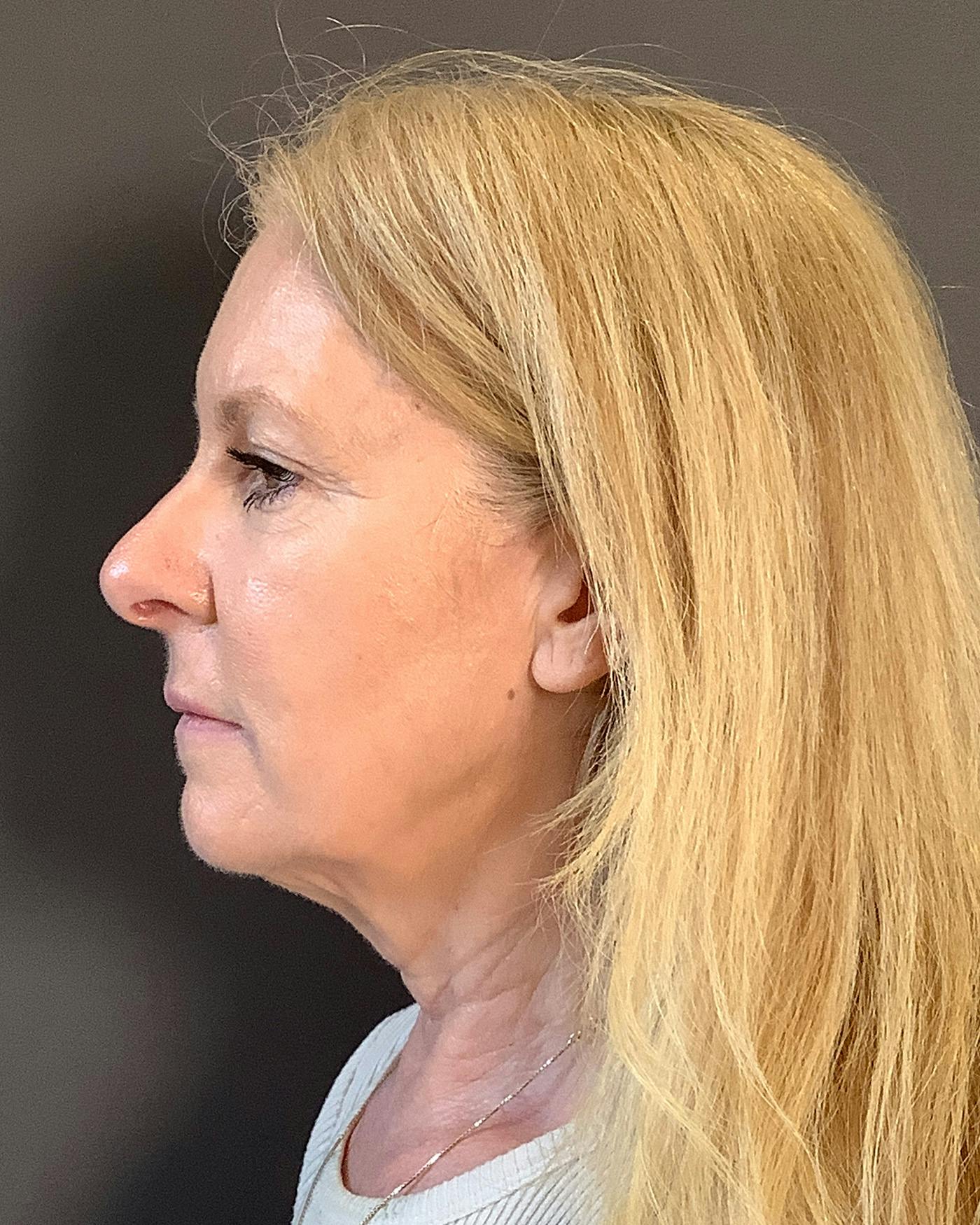 CO2 Full Face Before & After Gallery - Patient 407428 - Image 9