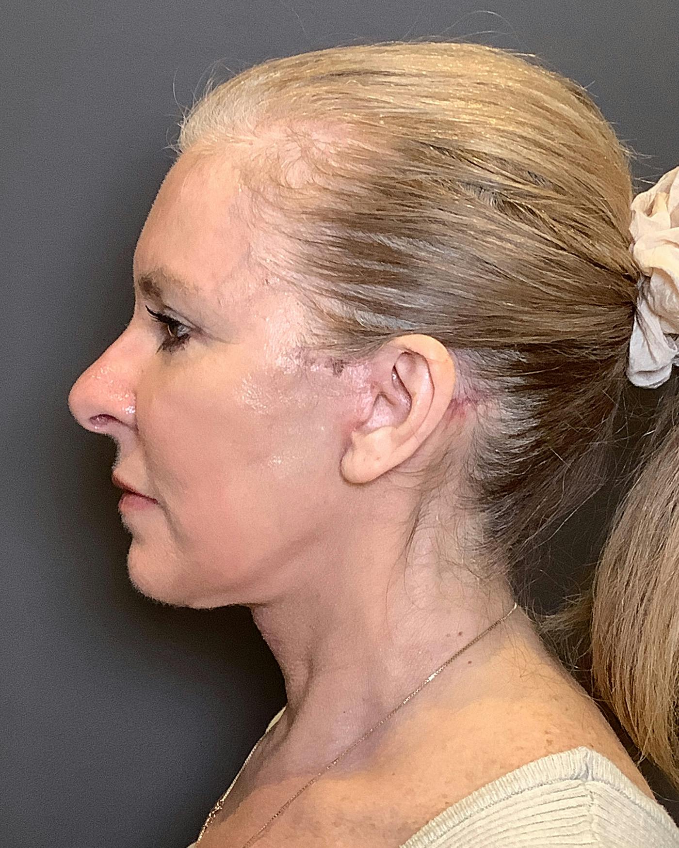 CO2 Full Face Before & After Gallery - Patient 407428 - Image 10