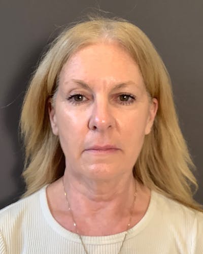 CO2 Full Face Before & After Gallery - Patient 407428 - Image 1